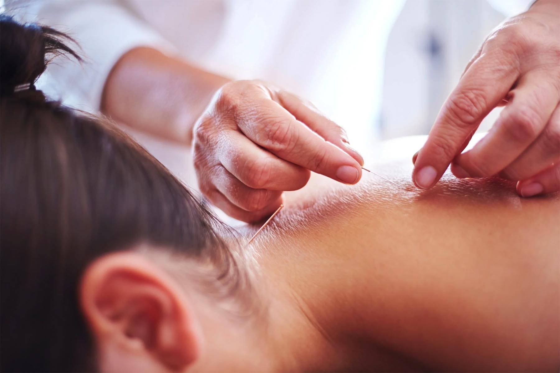 Gentle acupuncture needle insertion for pain and stress relief