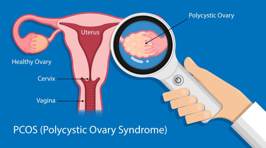 Common symptoms of PCOS including fatigue, irregular periods, and weight gain